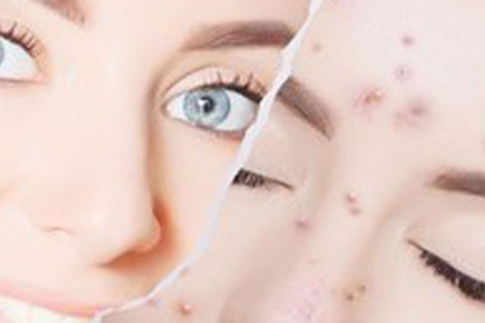 Acné, un problema sin edad